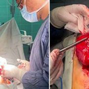 خارج کردن تومور شکمی از بدن کودک ۱۰ساله در مرکز آموزشی و درمانی ۱۷ شهریور رشت